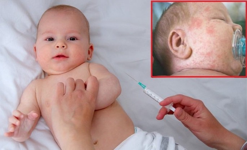 Phân biệt 3 dạng phát ban ở trẻ: sởi, sốt phát ban và Rubella