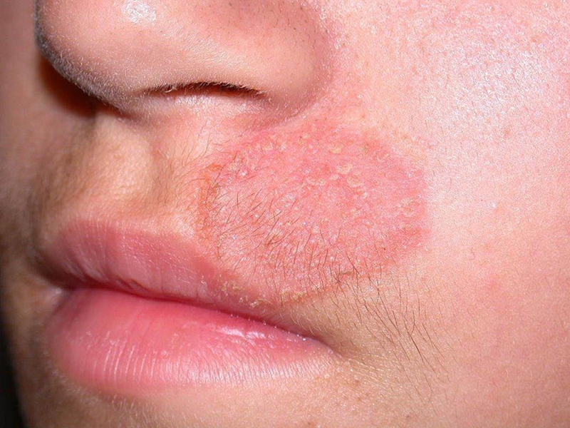 Hắc lào mãn tính có chữa được không? Có tái phát không? 4