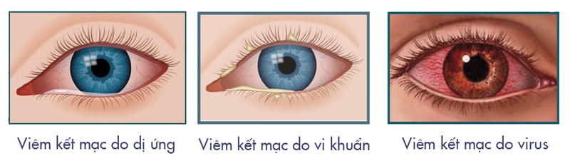 Phân biệt bệnh đau mắt trắng và đau mắt đỏ