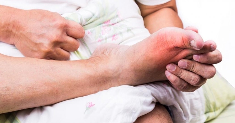 Những dấu hiệu đầu tiên của bệnh gout là gì? 3