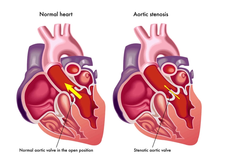 Phân biệt bệnh hở và hẹp van tim để nâng cao kết quả điều trị