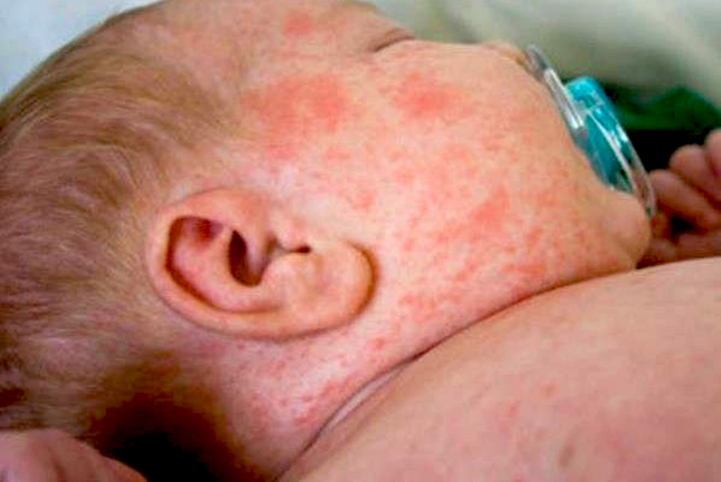 Phân biệt bệnh sởi và rubella ở trẻ để chữa trị đúng, an toàn, hiệu quả 1
