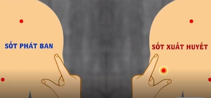 Phân biệt bệnh sốt xuất huyết với sốt thông thường