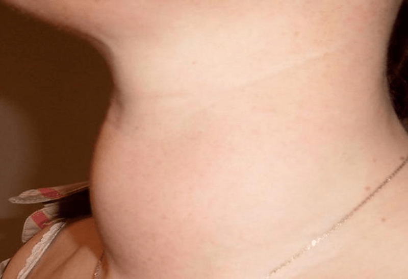 Phân biệt bướu cổ và u tuyến giáp. Nguyên nhân và cách điều trị 1