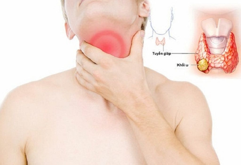 Phân biệt bướu cổ và u tuyến giáp. Nguyên nhân và cách điều trị 2