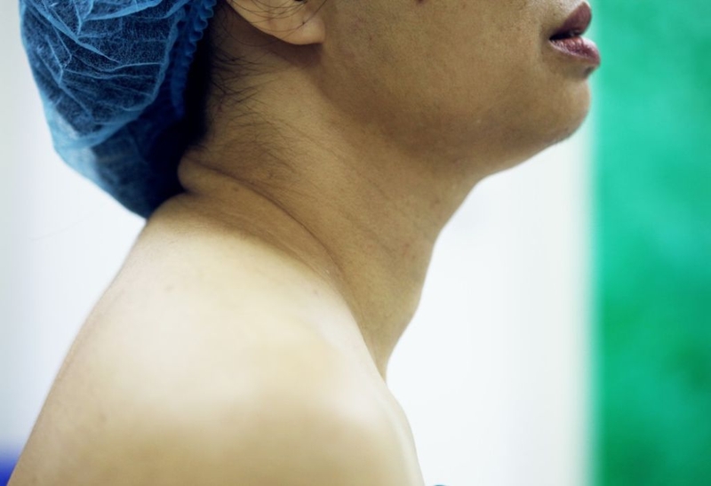 Phân biệt bướu cổ và u tuyến giáp. Nguyên nhân và cách điều trị 3