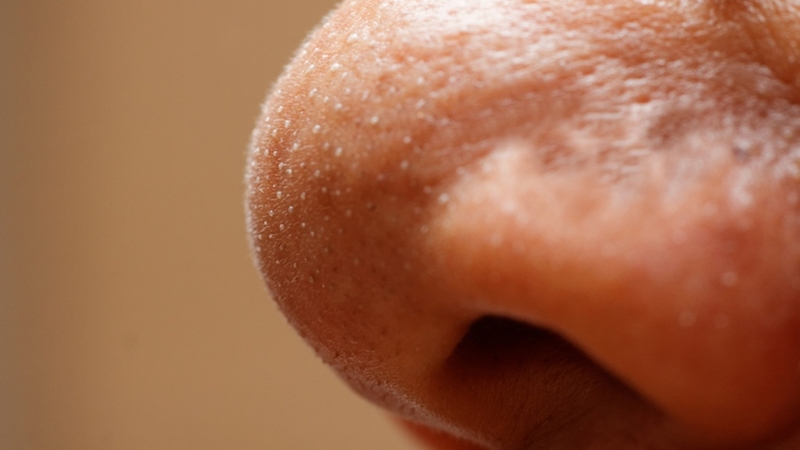 Phân biệt các loại mụn và cách trị mụn đúng chuẩn 2