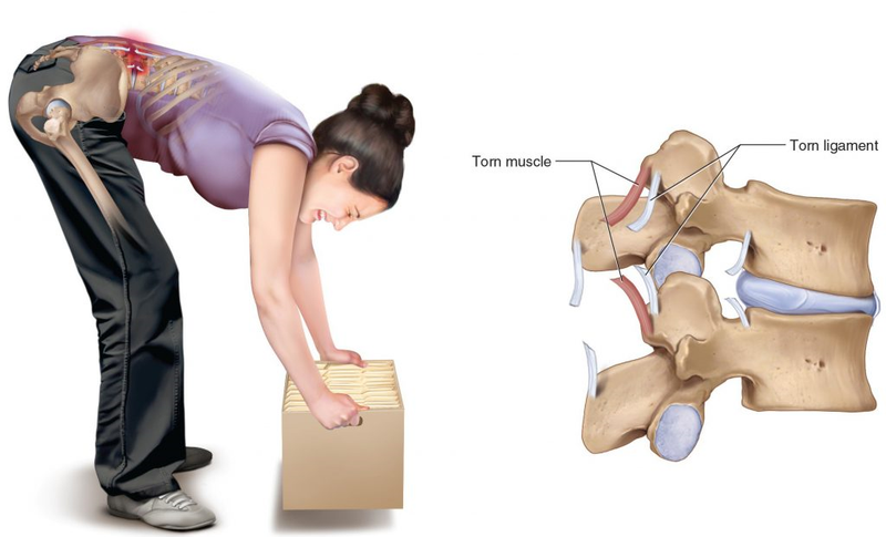 Phân biệt đau lưng dưới thắt lưng do đĩa đệm và căng cơ 4