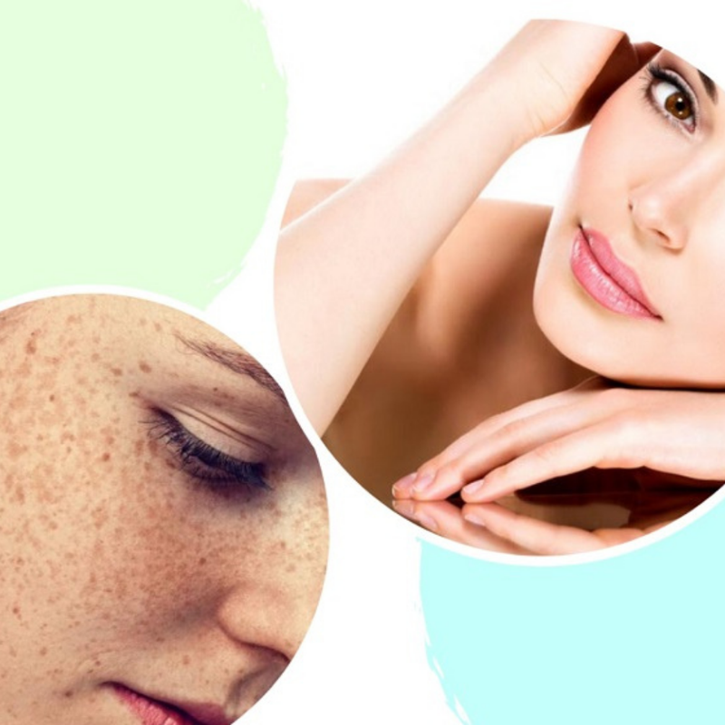 Phân biệt đồi mồi và tàn nhang trên da mặt 3