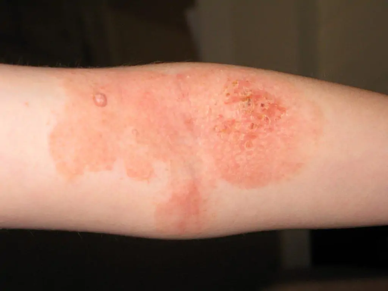 Phân biệt eczema và hắc lào như thế nào 3