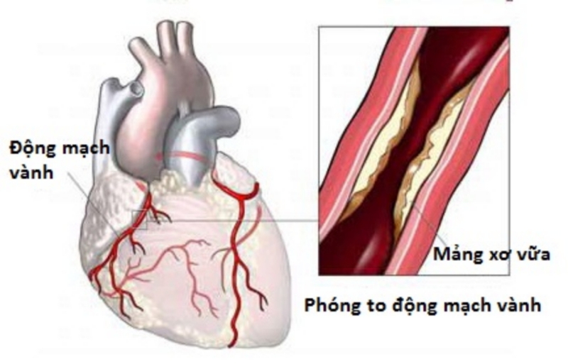 Phân biệt giữa nhồi máu cơ tim và đột quỵ - 1