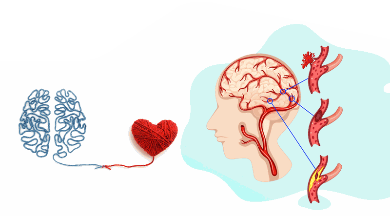 Phân biệt giữa nhồi máu cơ tim và đột quỵ - 3