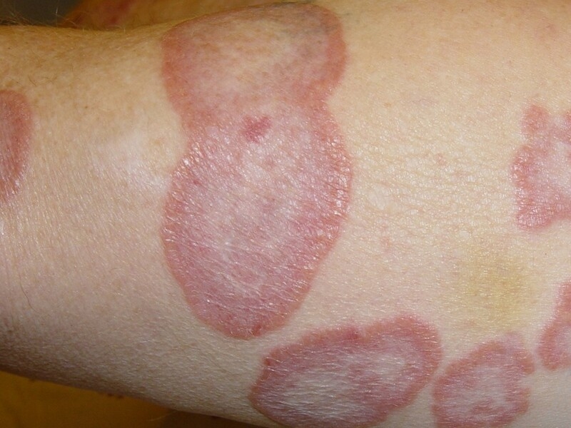 Phân biệt hắc lào, tổ đỉa: Nguyên nhân, triệu chứng và cách điều trị 1