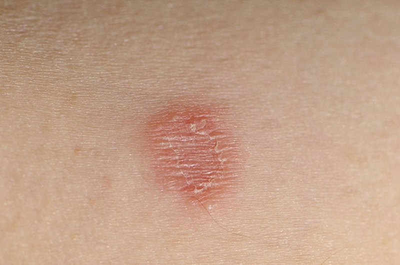 Phân biệt hắc lào, tổ đỉa: Nguyên nhân, triệu chứng và cách điều trị 3