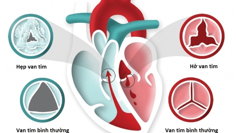Phân biệt hở và hẹp van tim: Tổng quan và phân biệt chi tiết 1