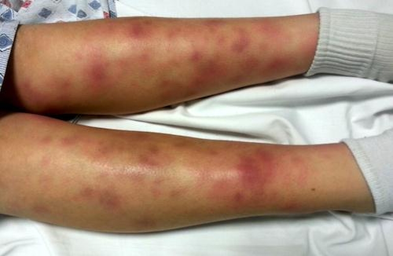 Phân biệt lupus ban đỏ và hồng ban nút 3