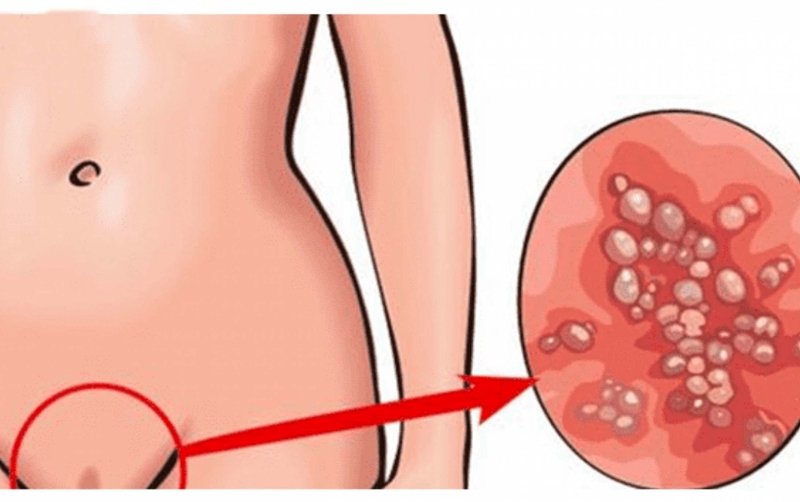 phan-biet-nguyen-nhan-trieu-chung-gay-mun-rop-sinh-duc-va-sui-mao-ga 3.jpg