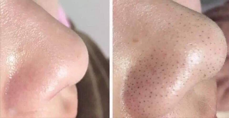 Phân biệt những loại mụn trên da 2