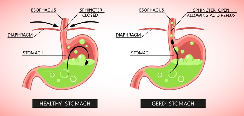 Phân biệt ợ chua, trào ngược axit và GERD như thế nào? 3