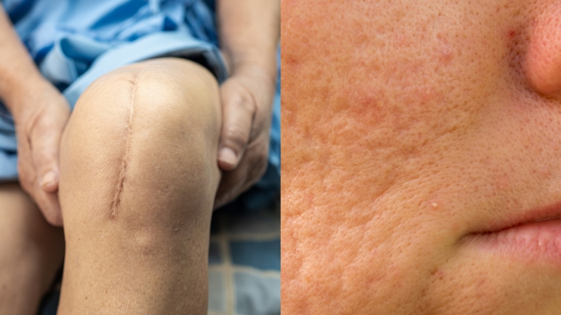 Phân biệt sẹo rỗ và sẹo lõm và cách điều trị chúng hợp lý 0