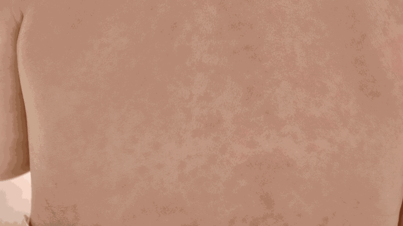 Phân biệt sốt phát ban và sởi: Những thông tin cần biết 1