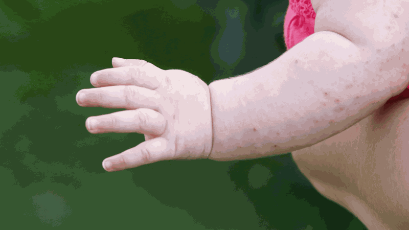 Phân biệt sốt phát ban và sởi: Những thông tin cần biết 2