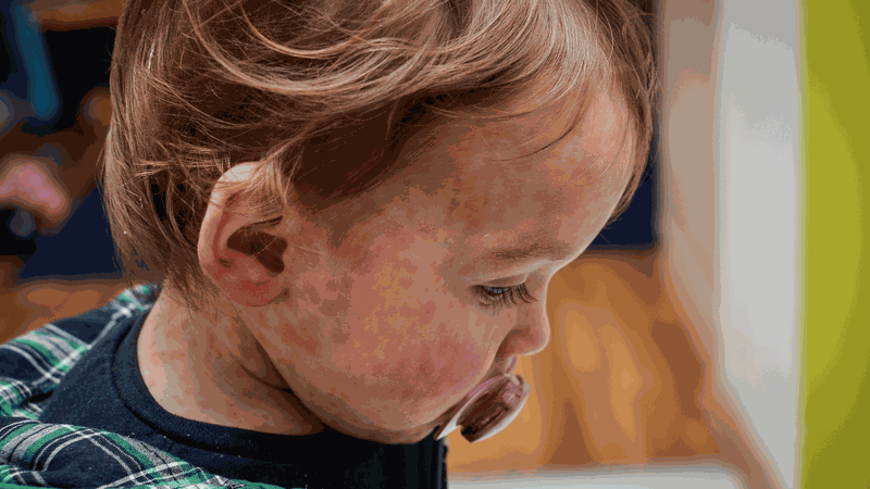 Phân biệt sốt phát ban và sởi: Những thông tin cần biết 3