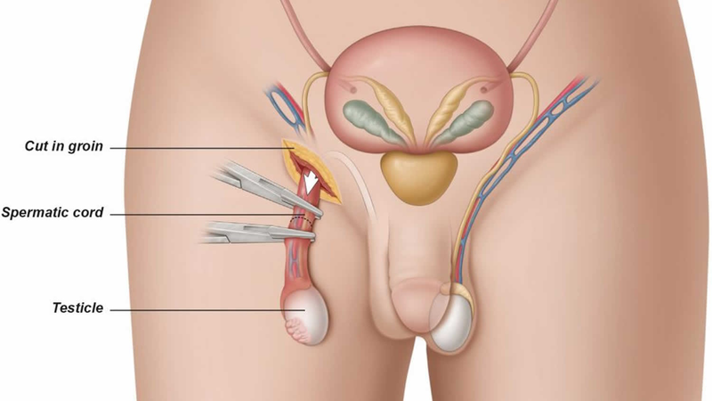 Phân biệt tinh hoàn lạc chỗ và tinh hoàn ẩn - 1