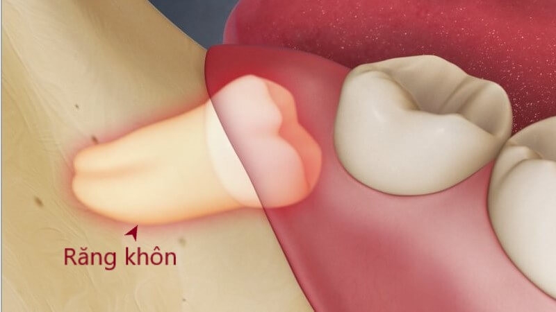 Phân biệt tình trạng đau do mọc răng khôn và quai bị 1