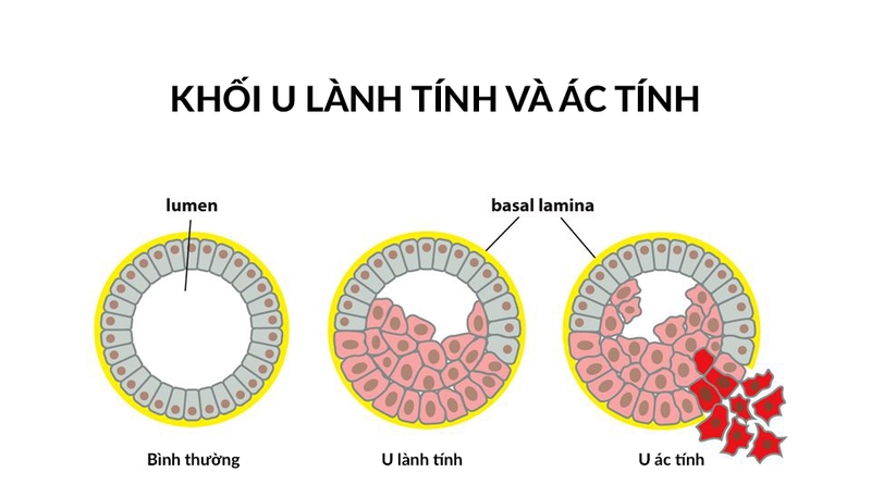 Thế nào là khối u lành tính?
