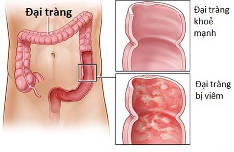 Phân biệt viêm đại tràng và hội chứng ruột kích thích 2