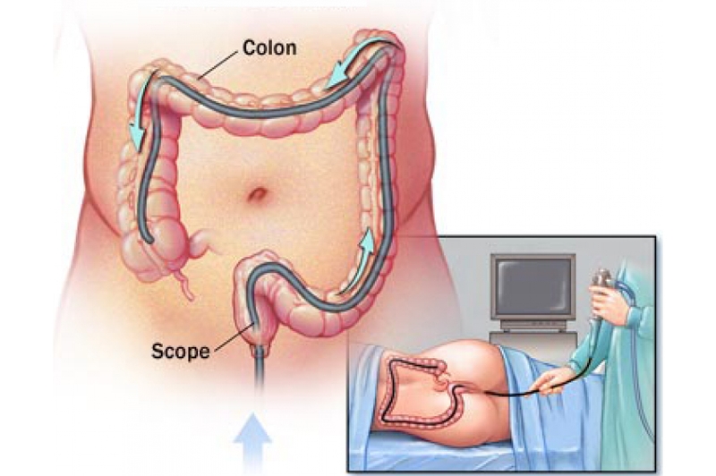 Phân biệt viêm đại tràng và hội chứng ruột kích thích 3