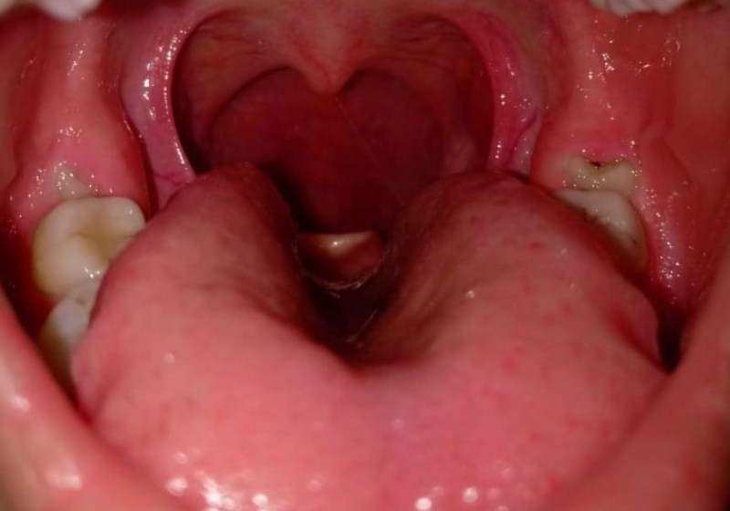 Phân biệt viêm họng hạt và ung thư vòm họng để tránh nhầm lẫn-3