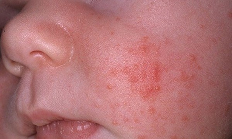 Phân biệt viêm họng phát ban da và sốt phát ban1