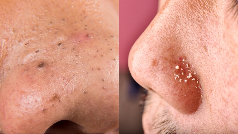 Mụn đầu đen và sợi bã nhờn có nhiều điểm khác biệt