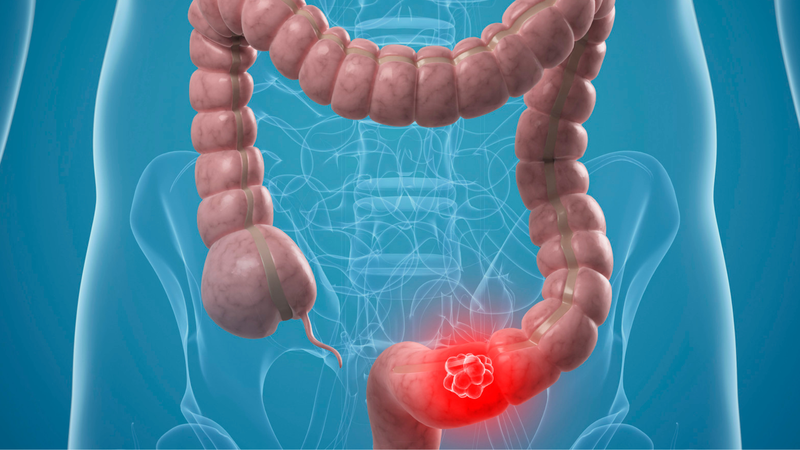 Phân dẹt hình lá lúa có phải dấu hiệu nhận biết ung thư đại tràng? 1