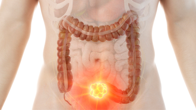 Phân dẹt hình lá lúa có phải dấu hiệu nhận biết ung thư đại tràng? 2