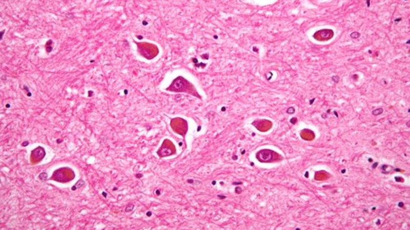 Phân độ bệnh não gan: Định nghĩa, triệu chứng và phương pháp điều trị 2