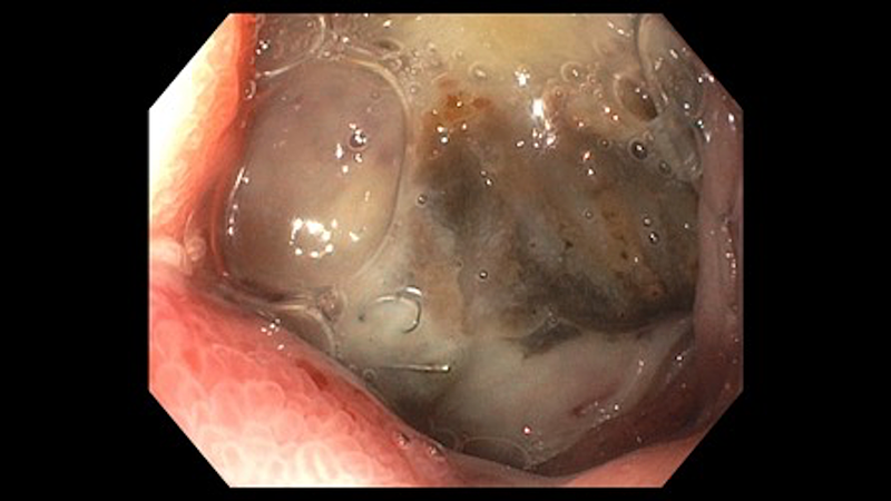 Phân độ Forrest ở những bệnh nhân loét dạ dày tá tràng 3