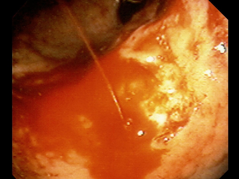 Phân độ Forrest ở những bệnh nhân loét dạ dày tá tràng 1