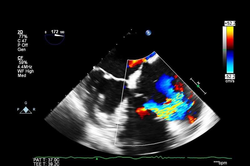 Tìm hiểu về phân độ Killip trong nhồi máu cơ tim cấp 4