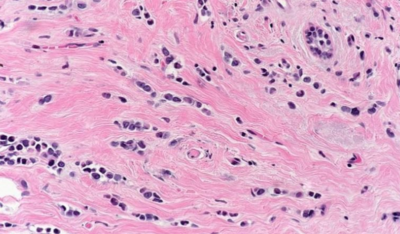 Tế bào ung thư vú qua kính hiển vi