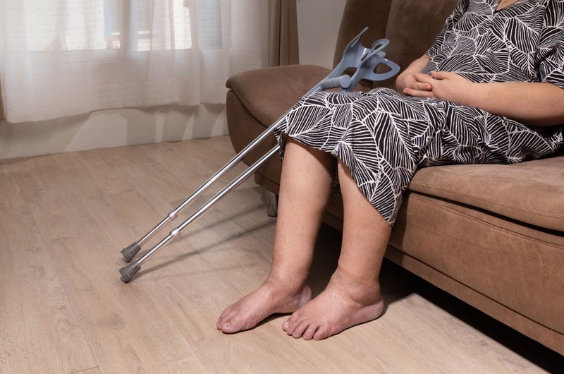 Tìm hiểu về các phân độ phù, nguyên nhân và cách điều trị 1