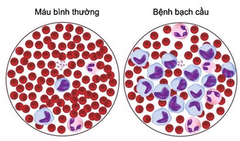 Số lượng bạch cầu trong phân loại bệnh bạch cầu cấp dòng Lympho ở trẻ em