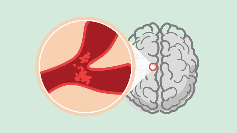 Phân loại các dạng đột quỵ và nguyên nhân gây đột quỵ 1