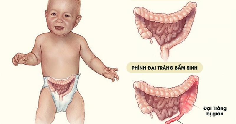 Phân su trẻ sơ sinh là gì? Có những bệnh lý phân su nào? 4