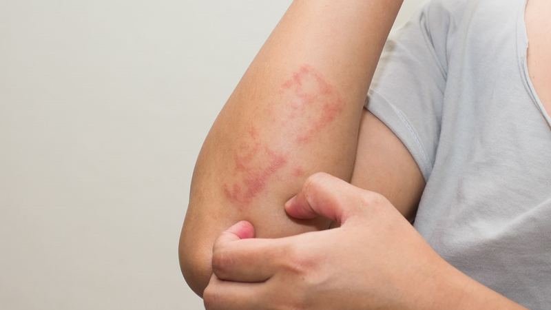 Phát ban HIV có ngứa không? Sự thật không ngờ 1