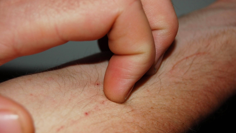 Phát ban HIV có ngứa không? Sự thật không ngờ 3