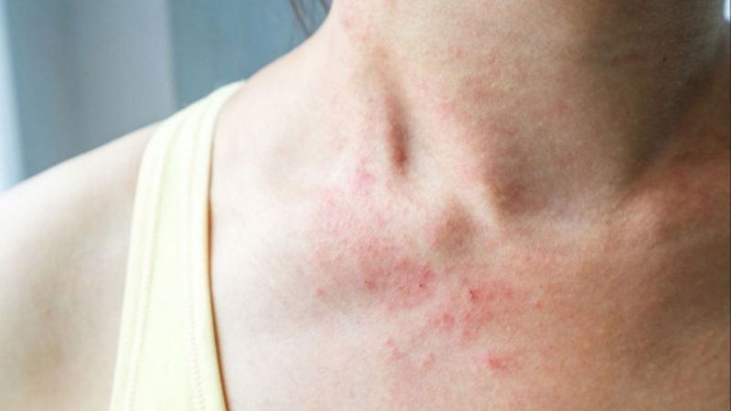 Phát ban keto là gì? Triệu chứng và cách điều trị 1