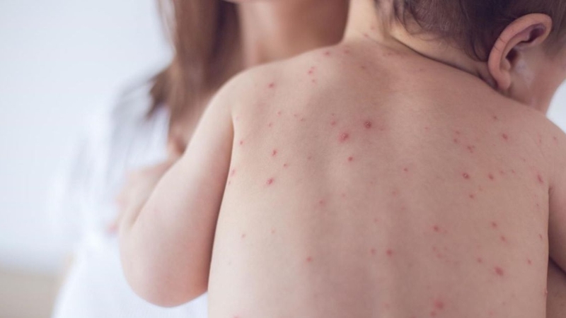 Phát ban nhiệt và cách điều trị hiệu quả 1